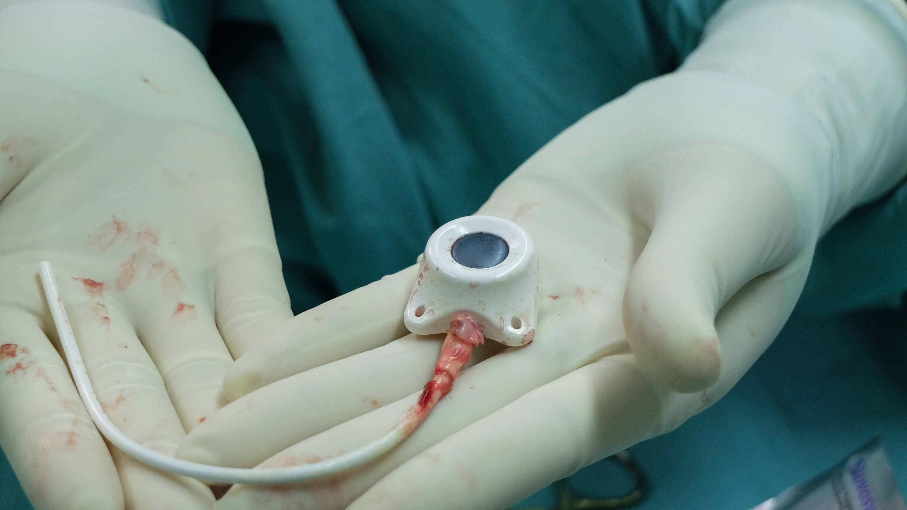 Bard Port Catheter Lawsuits Edgar Snyder & Associates